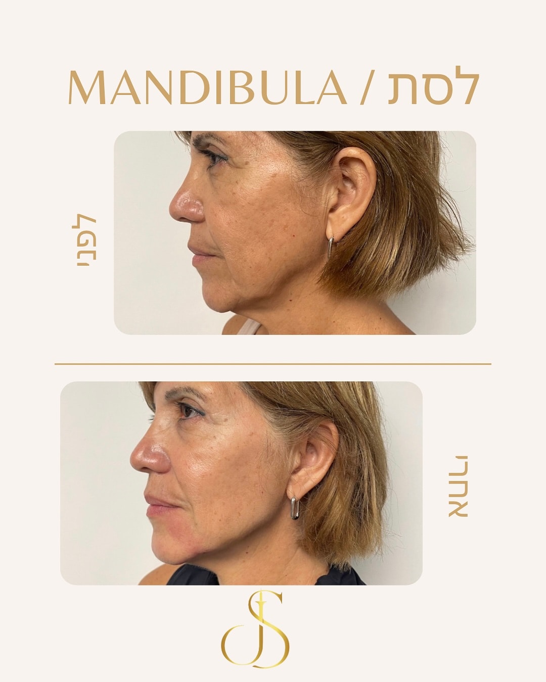 לסת — Mandibula