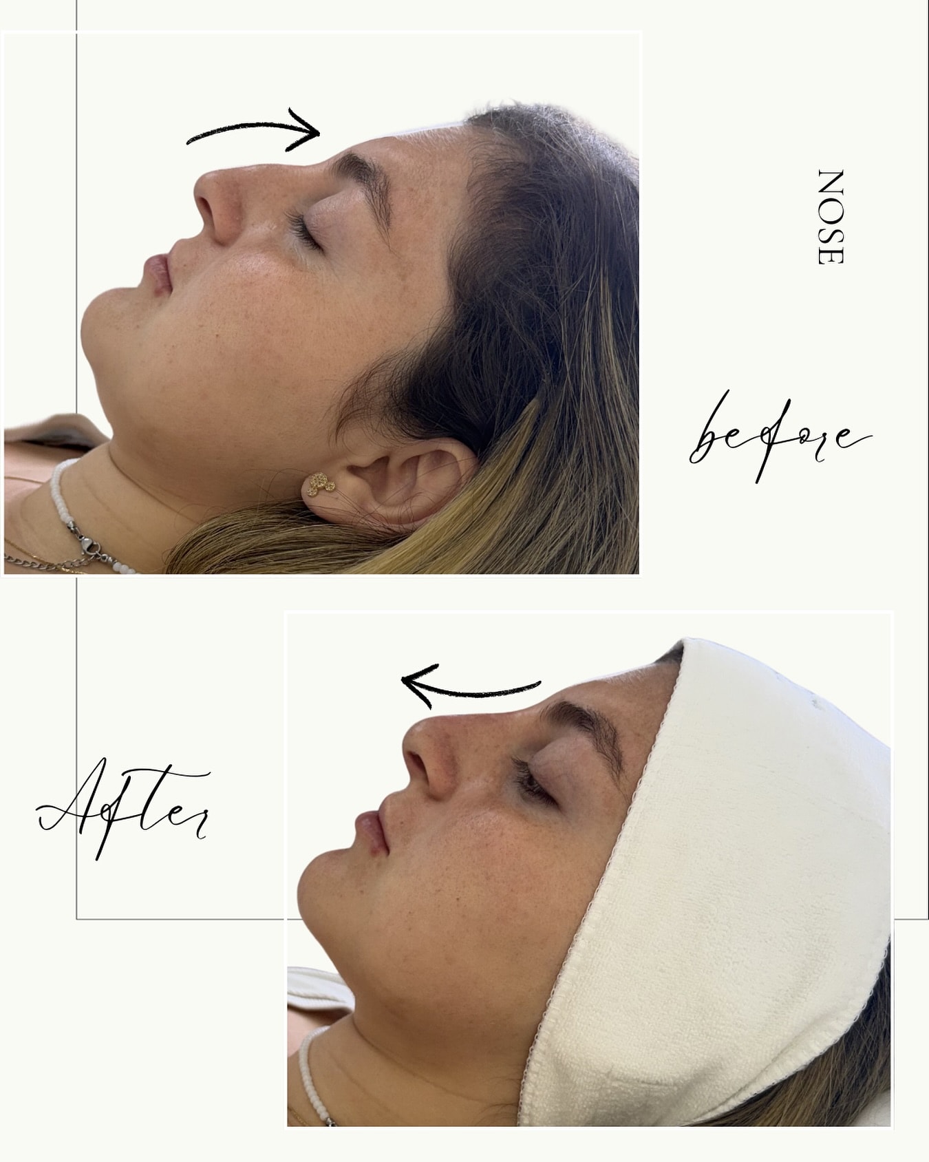 אף — rhinomodeling